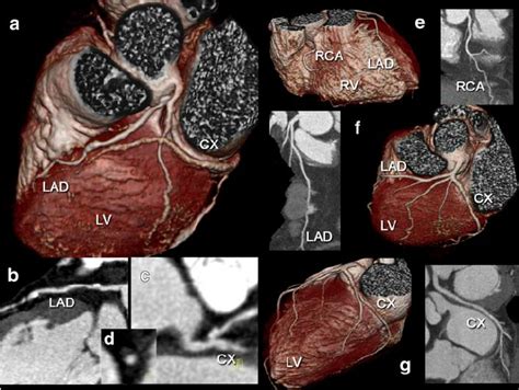 Examples Of CTCA In Two Patients The First Patient A D Was A