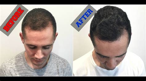 Grow Back Your Hair With Platelet Rich Plasma Prp Treatment Youtube