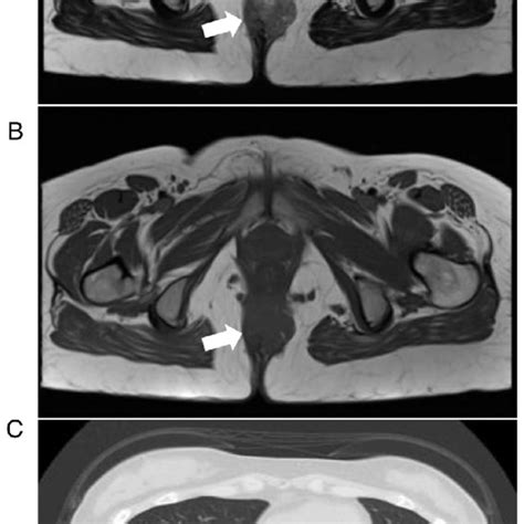 Mri Images A T2 Weighted Image B T1 Weighted Image A 60 Mm