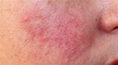 Management Of Rosacea Guidelines By The British Association Of Dermatologists