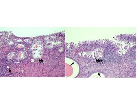 Resting endometrium (1 arrow); clear cell endometrial glandular ...