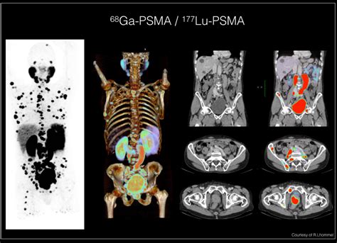 Cancer De La Prostate Institut Roi Albert Ii