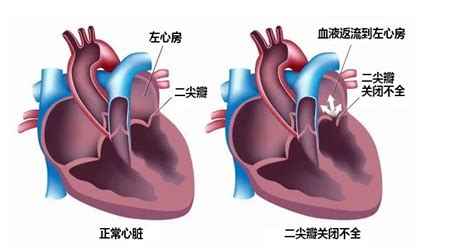 二尖瓣闭锁不全图册 360百科