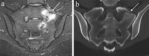 Synthetic Ct And The T2 Short Ti Inversion Recovery Stir Sequence Are