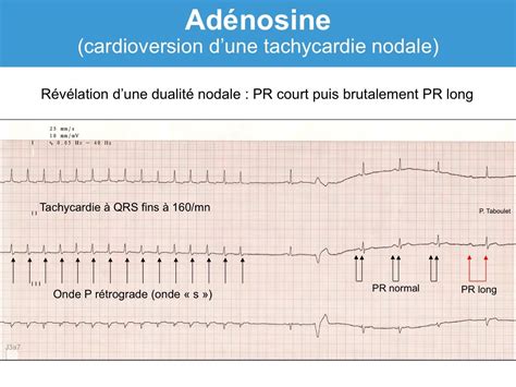 Adénosine (ATP). Indications : e-cardiogram