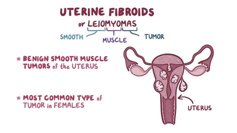 Uterine Fibroids Symptoms Causes Complications And 50 OFF