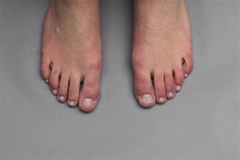 Covid Toe How Coronavirus Can Affect Your Feet