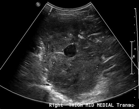 Imaging Features Of Myxoid Soft Tissue Tumours Clinical Radiology