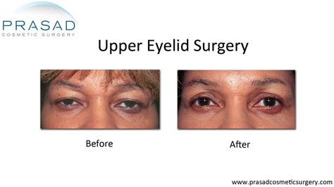 Upper Blepharoplasty Gone Wrong