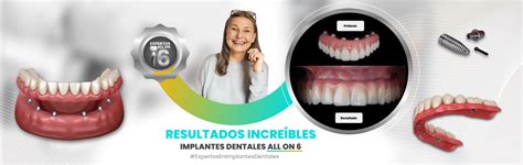 Implantes All On 6 Dental Cop El Salvador