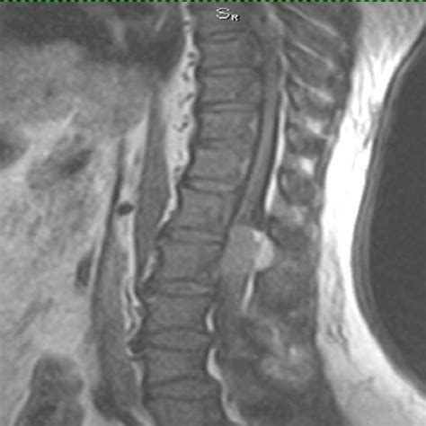 Se observa a nivel del cono medular L1 L2 una lesión con una intensidad