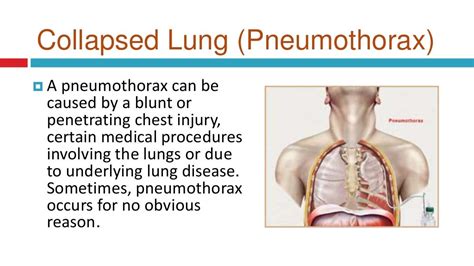 Pneumothorax Collapsed Lung Symptoms Causes And Treatment In Del…