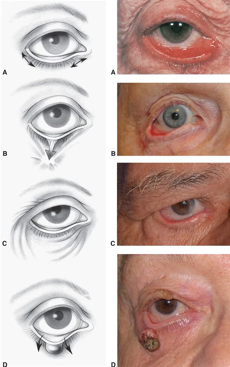 Ectropion