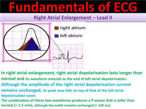 P wave abnormalities in ECG | PPT