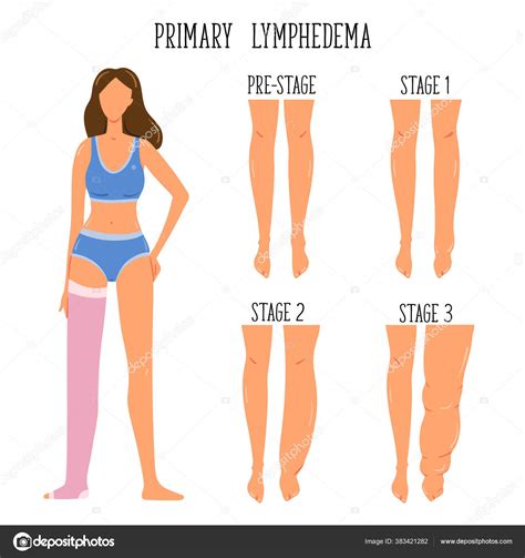 Primary Lymphedema Stages Lymphatic System Disfunction Elephantiasis