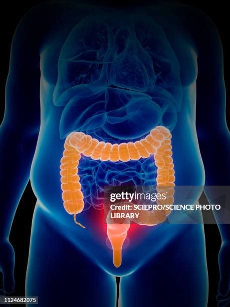 Colon Cancer Scientific Illustration Photos And Premium High Res