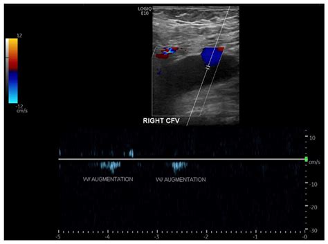 The Sonographic Detection Of An Obstructive Pelvic Lymphocele Evan