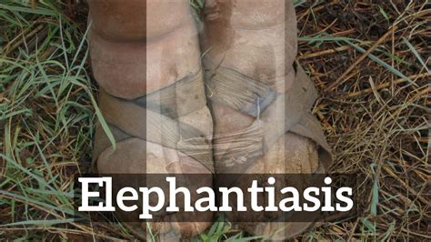 How To Say Elephantiasis In English What Is Elephantiasis How