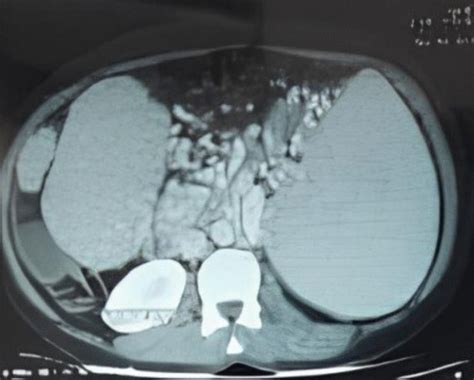 Giant Renal Angiomyolipoma A Rare And Formidable Challenge A Case