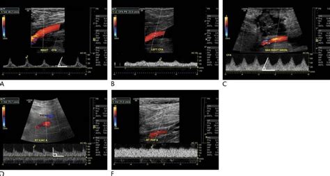 Spectral Doppler Waveforms In The Setting Of Lvads A Monophasic