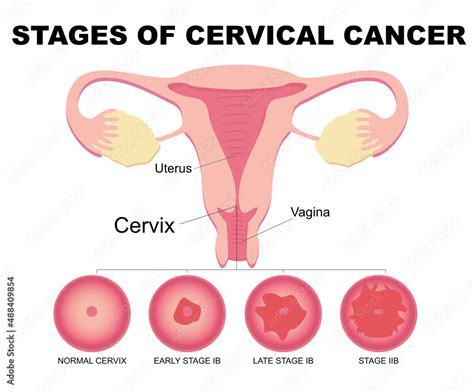 Flat Illustration Of Cervical Cancer Stages Diseases Of The Female