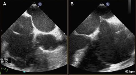 Transesophageal Echocardiography Image Transseptal Puncture A