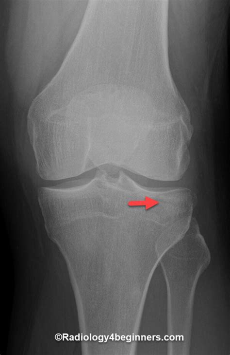 SegondFracture Radiology - ACL injury | Radiology For Beginners