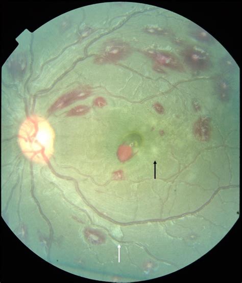 Cerebral Malariausing The Retina To Study The Brain Eye