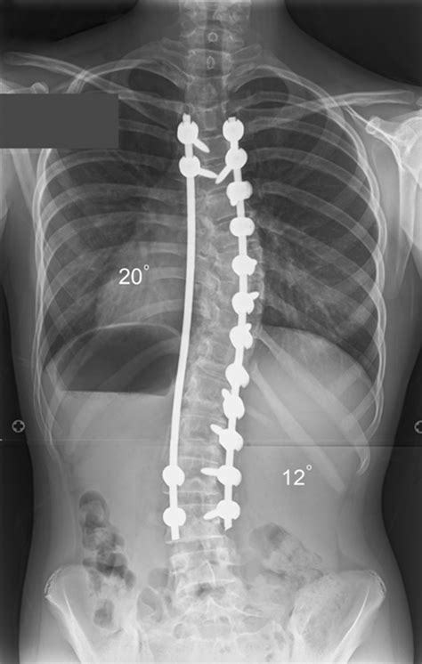 Posterior Spinal Arthrodesis For Adolescent Idiopathic Scoliosis Using Pedicle Screw