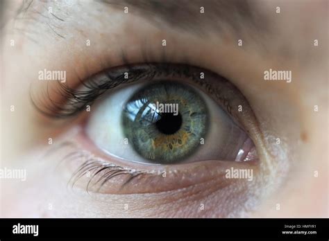 Eye Close Up Showing A Sectoral Heterochromia Of The Iris