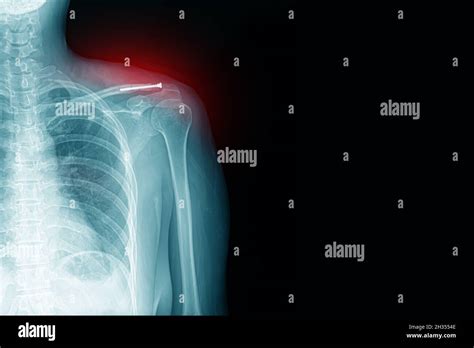 Fractura De Clavicula Paciente Banque De Photographies Et Dimages