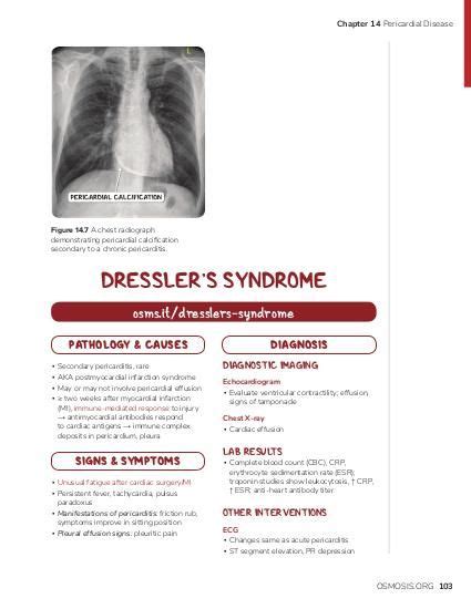 Dressler syndrome | Osmosis