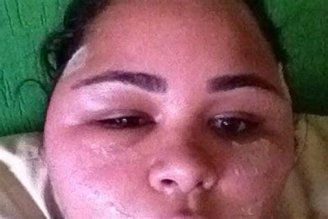 Botched face lift victims left with ‘deformed’ faces sue Brazilian doctor they claim pumped ...