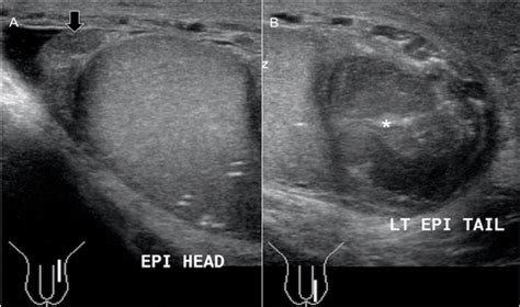 Scrotal Wall Ultrasound