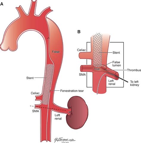 Endovascular Management Of Malperfusion Syndromes In Aortic Dissection