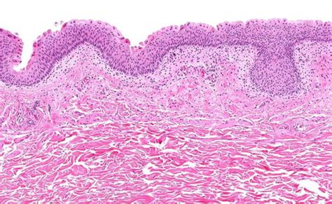 Interstitial Cystitis Treatments