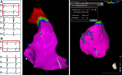 Brugada Syndrome Phenotype Elimination By Epicardial Substrate Ablation