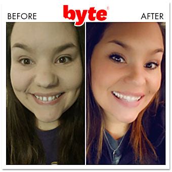 Byte Before & After Photos: Pics of Real Customer Results