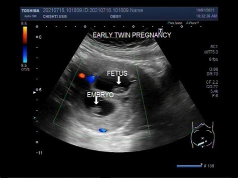 Twin Ultrasound 8 Weeks