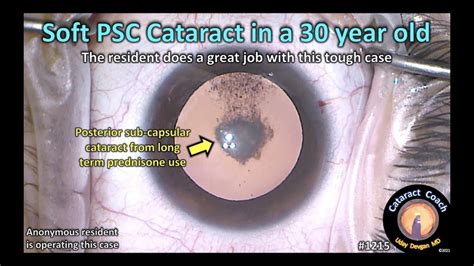 Posterior Subcapsular Cataract