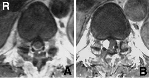 Figure From Rapid Regrowth Of A Capillary Hemangioma Of The Thoracic