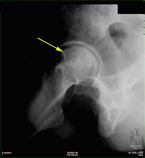 Avascular Necrosis Femoral Head Ct