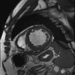 Cardiac Magnetic Resonance Imaging Showing Left Ventricular