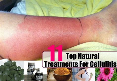 11 Top Natural Treatments For Cellulitis Cellulitis Treatment Natural Cures Natural Treatments