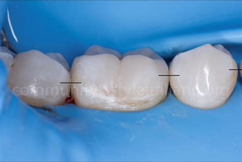 Proximal composite restoration from cavity design to polishing ...