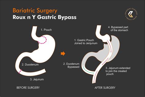 What Is Roux N Y Gastric Bypass Surgery Dr Ebrahim Mansoor