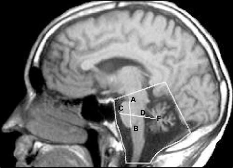 Resonancia Magn Tica Corte Sagital Medial Delimitaci N De La Fosa