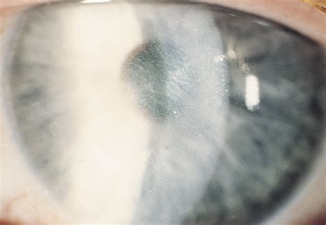 Late Occurrence Of Diffuse Lamellar Keratitis After Laser In Situ Keratomileusis Jama