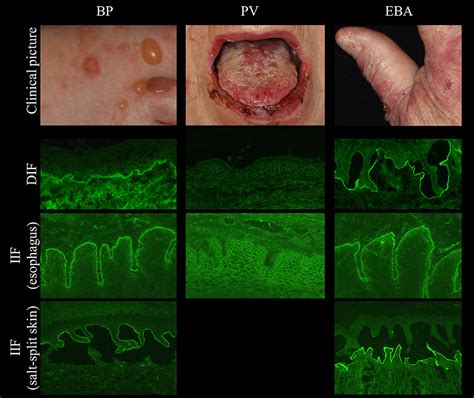 Frontiers Diagnosis Of Autoimmune Blistering Diseases