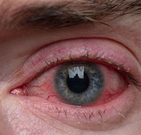 Red Eyes: Causes and Treatment